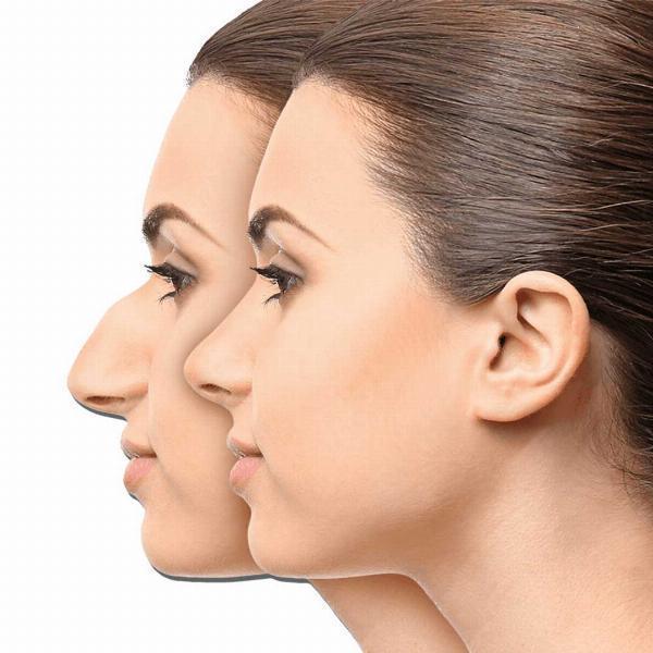 Rhinoplasty in Islamabad: Balancing Cultural Sensitivity with Aesthetic Goals