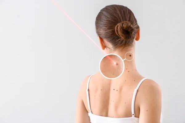 How Precision Dermoscopy Improves Mole Assessment in Dubai Clinics