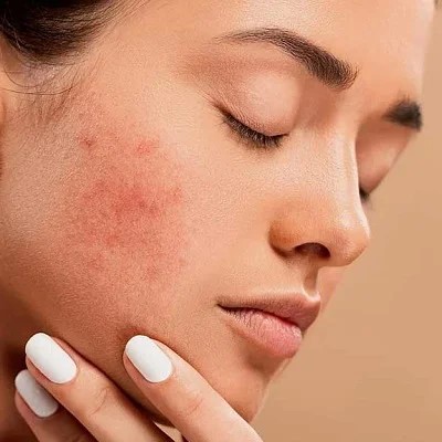 Acne Treatment Abu Dhabi: Practical Guide to Clear, Confident Skin