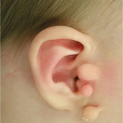 Preauricular Tag Removal Abu Dhabi: Procedure, Costs, Recovery and Clinic Selection
