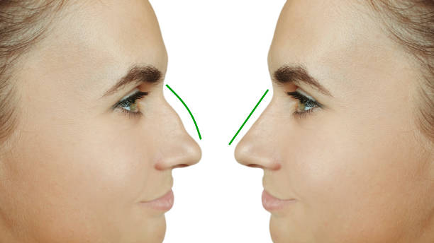 Hiko Nose Thread Lift Abu Dhabi: Complete Guide to Non-Surgical Rhinoplasty