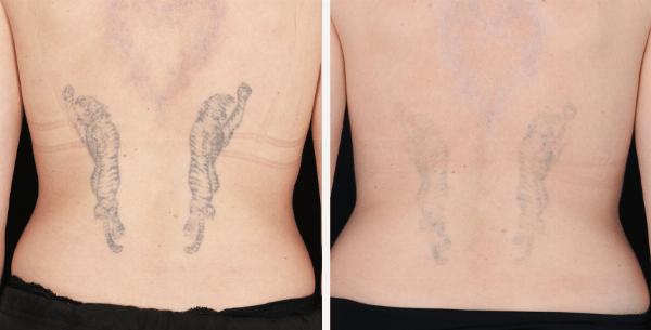 Is Laser Tattoo Removal Linked to Cancer? Current Evidence Explained