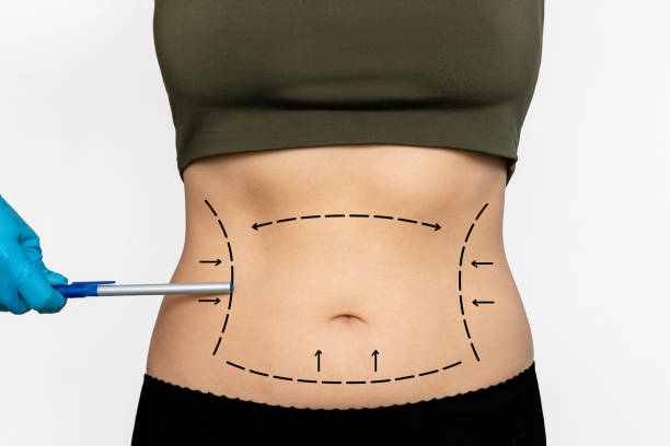 Abdominal Liposuction in Riyadh: Techniques, Safety, Cost and Recovery Guide