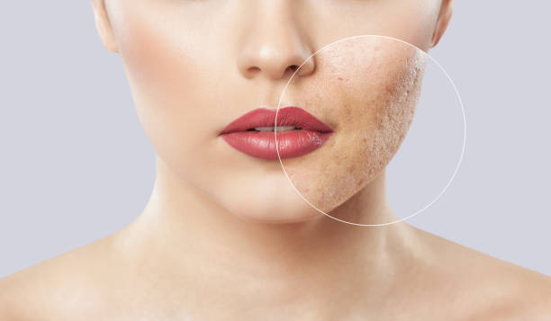 Large Pore Treatment in Riyadh: Clinic Options, At-Home Essentials, and Costs