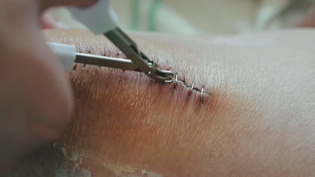 How Dubai Residents Can Safely Remove Sutures at Home: A Practical Guide