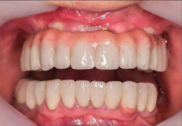 Full Mouth Rehabilitation in Dubai: Comprehensive Guide to a Complete Dental Makeover