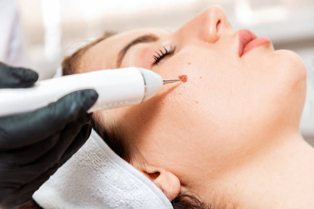 Wart Removal Treatments: Options, Effectiveness, and Recovery