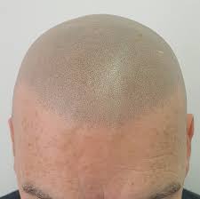 Scalp Micropigmentation vs Hair Transplant in Dubai: A Practical Comparison