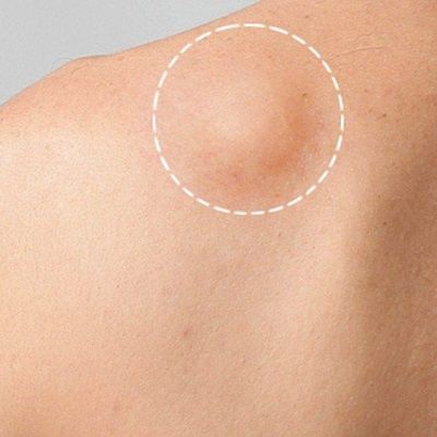 Lipoma Treatment in Dubai: Complete Patient Guide and Costs
