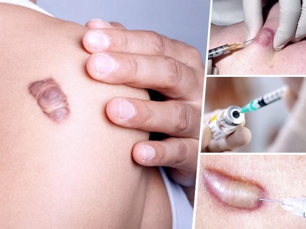 Keloid Removal Costs in Dubai: Typical Fees, Treatments, and What Influences Price