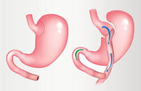 Mini Gastric Bypass in Dubai — Comprehensive Guide to Procedure, Recovery, and Costs