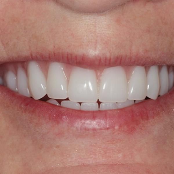 Dental Implants vs Dentures in Dubai: Benefits, Costs, and Care