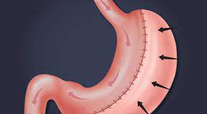 Revision Bariatric Surgery in Dubai: Options, Risks, and Recovery
