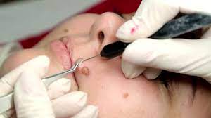 Mole Removal in Dubai: Treatments, Costs, Risks & Recovery Guide
