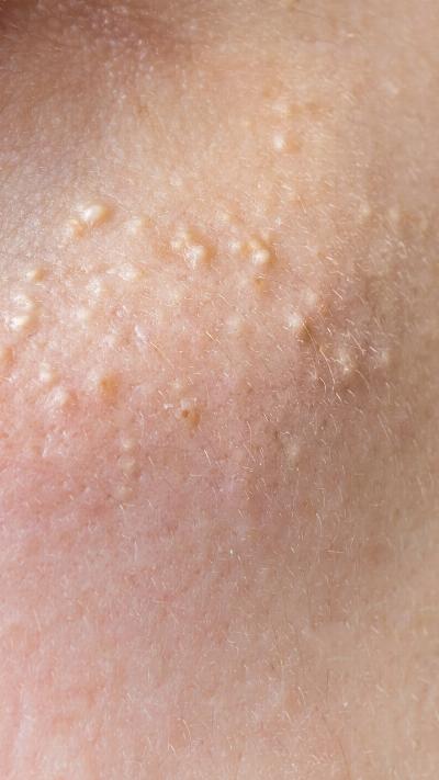 Advanced Milia Removal in Dubai: Treatment Options, Safety, and Aftercare