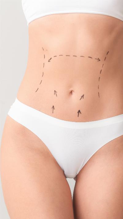 Liposuction in Riyadh: Complete Patient Guide to Choosing a Clinic and Preparing for Surgery
