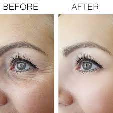 Quick & Painless Wrinkle Smoothing in Dubai: Lunchtime Treatments Explained