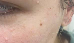 Milia vs Whiteheads: How to Tell the Difference, Causes, and Care