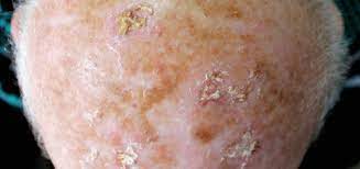 Actinic Keratosis Treatment Options, Risks, and Prevention Guide