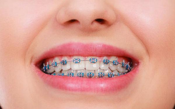 Choosing Between Metal Braces and Clear Aligners: A Practical Guide