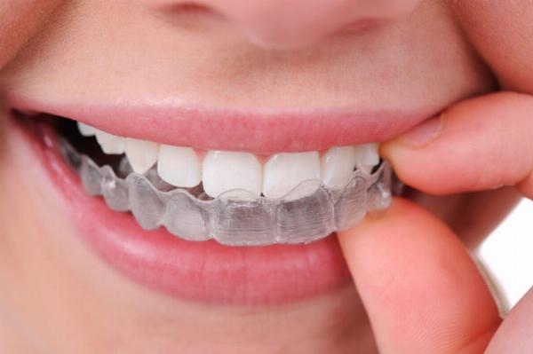 Night Guard Splint Guide: Choosing the Best Option for Teeth Grinding