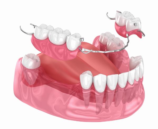 Dentures in Dubai: A Practical Guide to Choosing the Best Type