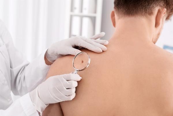 Seborrheic Keratosis Laser Removal in Dubai: Safety, Costs, and What to Expect