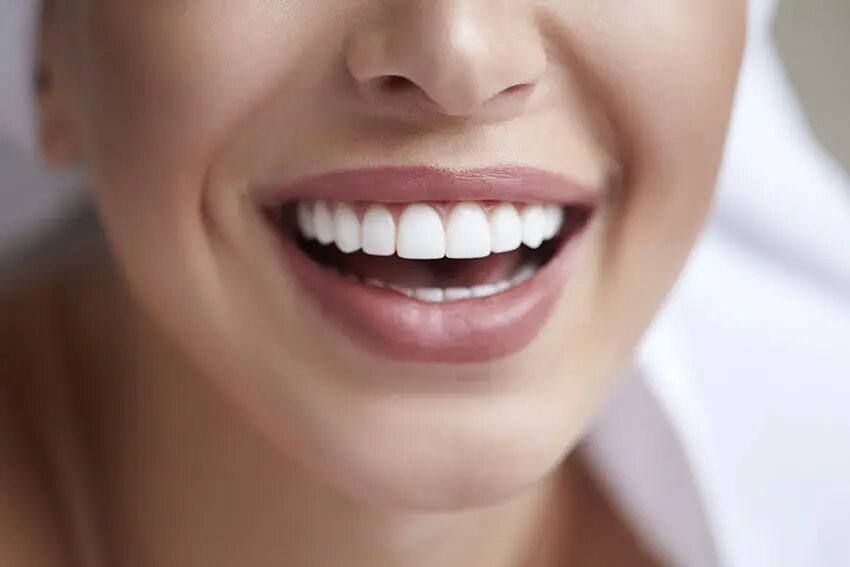 Affordable Dental Veneers in Dubai: Smart Ways to Cut Costs