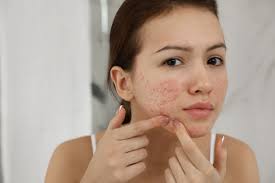 Does Glutathione Cause Acne? Evidence-Based Review and Practical Guidance