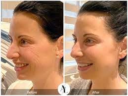 Plasma Pen vs. Other Skin Rejuvenation Treatments: Clear Comparison and When to Choose Each