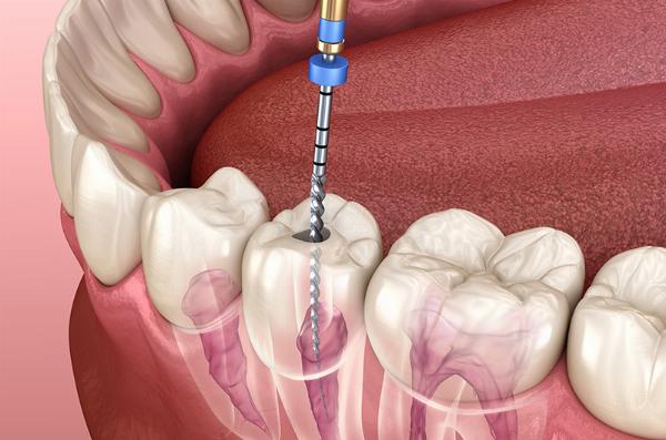Complete Guide to Root Canal Therapy in Dubai: Costs, Process, and Choosing a Clinic