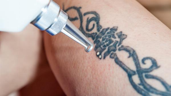 Comprehensive Guide to Laser Tattoo Removal in Dubai: Safe, Advanced, and Effective