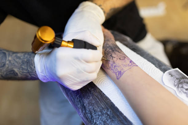 Clear Canvas: Trends and Options for Tattoo Removal in Riyadh