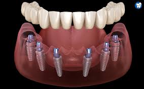 How Much Does a Single Tooth Implant Cost in Dubai? Price Breakdown and Clinic Guide