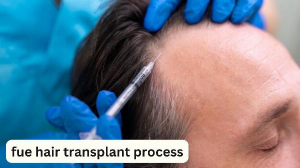 The FUE Hair Transplant Process: A Comprehensive Guide