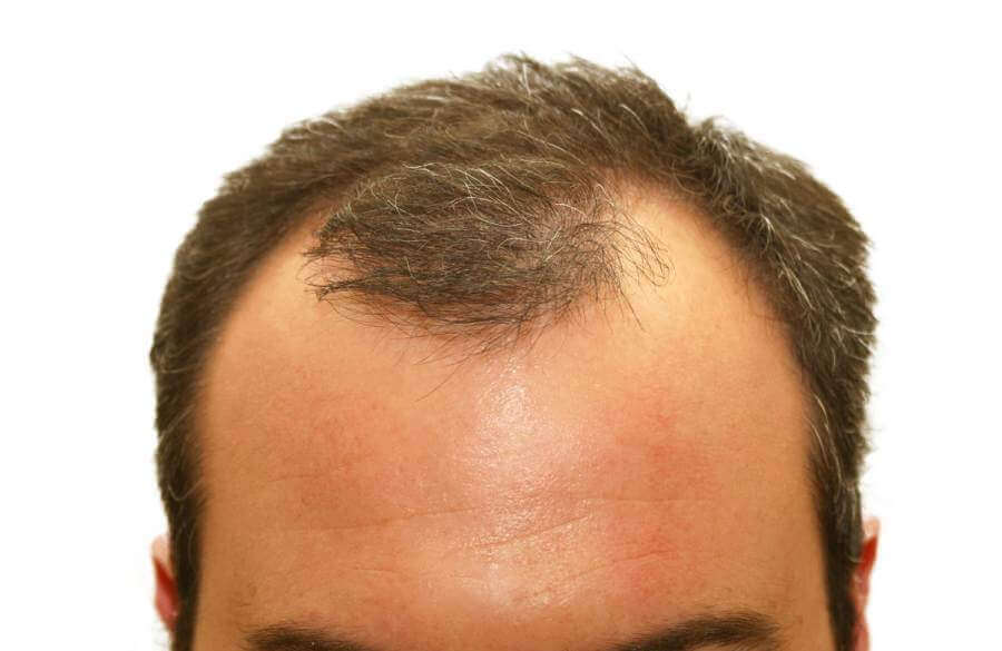 Finasteride Cost in Dubai: Prices, Fees, and Practical Savings Guide