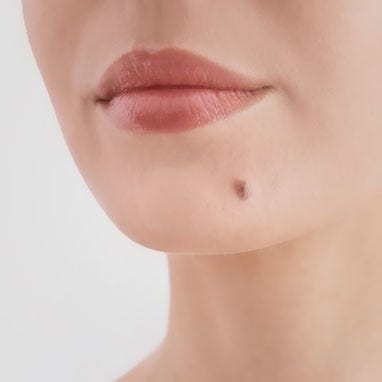 Mole Removal in Dubai: Safe Options, Expected Costs, and Recovery Guide