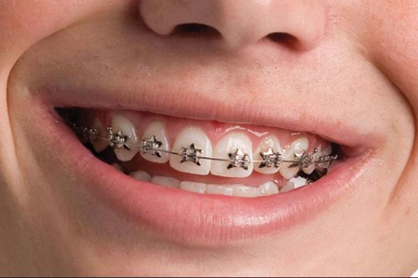 Best Dental Braces in Dubai: Types, Costs, and How to Choose