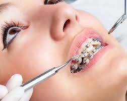 How Braces Influence Speech: Causes, Timeline, and When to Seek Help