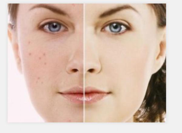 Acne Scar Treatment in Dubai: Complete Guide to Options, Costs, and Choosing a Clinic