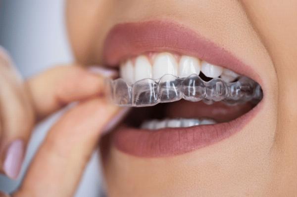 Clear Aligners in Dubai: Benefits, Cost, Clinics and How to Choose