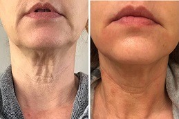 Fractional RF Microneedling in Dubai: Guide to Treatment, Benefits, and Safety