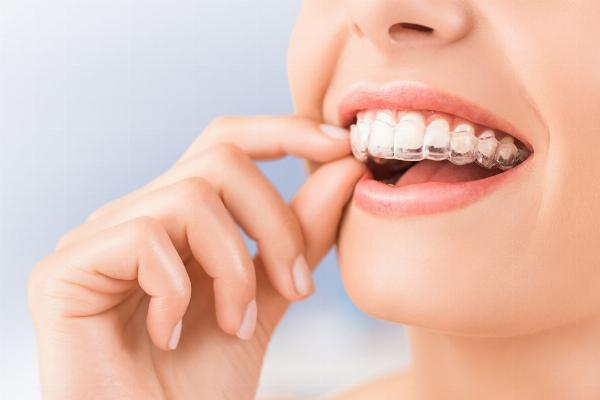 The Ultimate Guide to Clear Aligners in Dubai