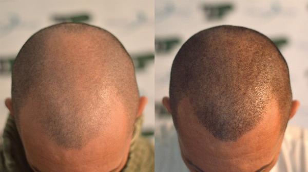 Dubai Scalp Micropigmentation Guide: Non-Surgical Hair Loss Options and Expectations