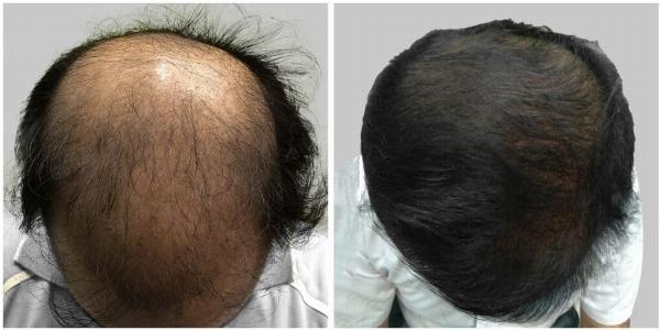 Finasteride in Dubai: A Practical Guide to Treating Hair Loss