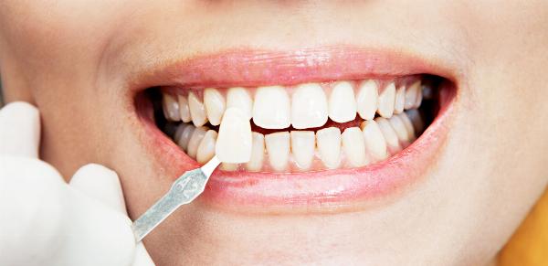 Affordable Composite Veneers in Dubai: Before-and-After Results and Cost Guide