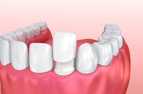 Dental Veneers in Dubai: A Practical Guide to Types, Process, and Aftercare