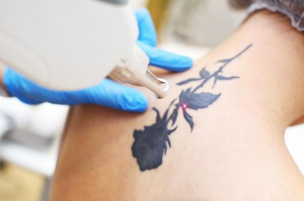 How to Choose Reliable Laser Tattoo Removal in Dubai: Options, Safety, and Cost