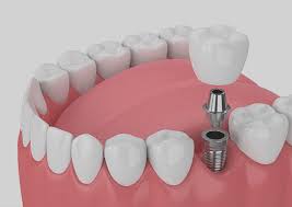 Dubai Single Tooth Replacement Costs: Complete Price Guide