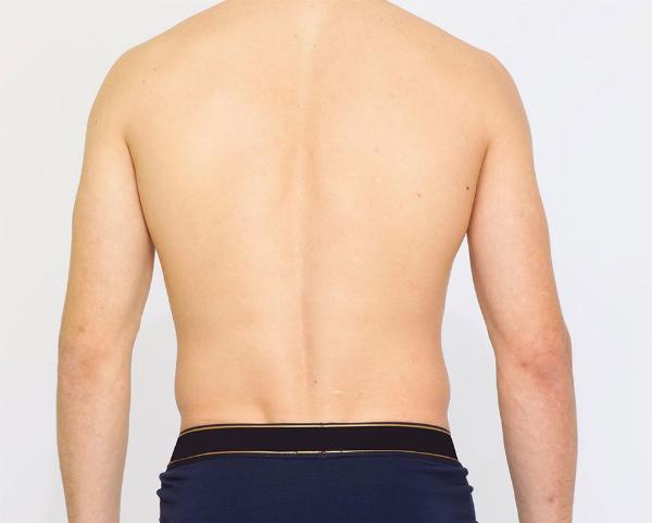 After Fat Dissolving Injections: Recovery Timeline, Aftercare, and Safety Tips